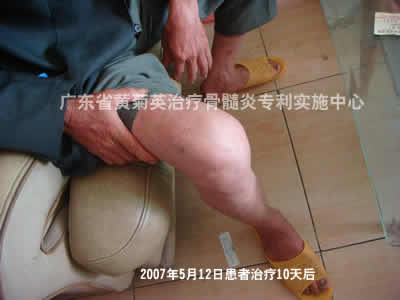 63岁膝关节骨髓炎治疗10天消肿止痛(图2)