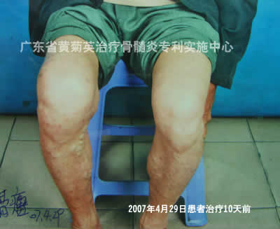 63岁膝关节骨髓炎治疗10天消肿止痛(图1)