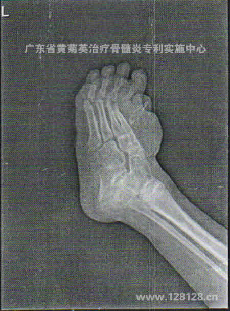 潮州患者一个月康复(图3)