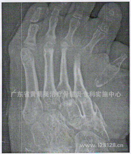 潮州患者一个月康复(图4)