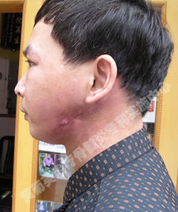 广西陆谋牙根骨髓炎(图4)