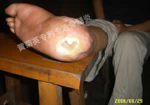 山东省20多年脚跟骨髓炎患者